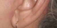 Incisions 01 / Fully healed facelift incision. 