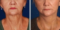 Laser Assisted Facelifts (SmartLifting) 01 / Before and after photo of a laser assisted full lower facelift with neck liposuction – ONE WEEK LATER! 
