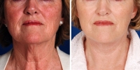 Laser Assisted Facelifts (SmartLifting) 02 / Dr. Khoury's laser assisted facelift patient before and after. 