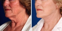 Laser Assisted Facelifts (SmartLifting) 03 / Dr. Khoury's laser assisted facelift patient before and after. 