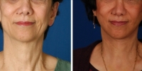 Laser Assisted Facelifts (SmartLifting) 06 / Only 7 days after SmartLifting(tm) procedure 