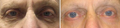 eyelid Lift - Patient Photo 2
