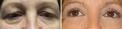 eyelid Lift - Patient Photo 3
