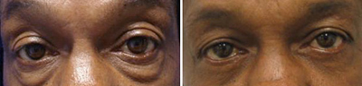 eyelid Lift - Patient Photo 4