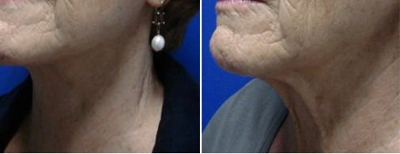 Neck Lift Patient Photo 1