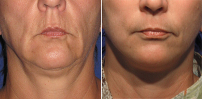 Face Lift - Patient Photo 1