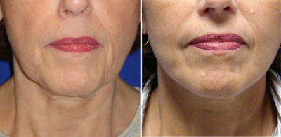 Face Lift - Patient Photo 2