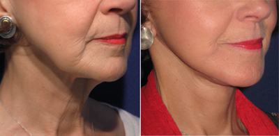 Face Lift - Patient Photo 3