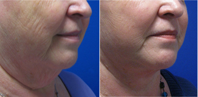Face Lift - Patient Photo 4