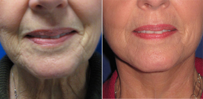 Face Lift - Patient Photo 5