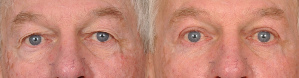 Eyelid Surgery Before and After Photos