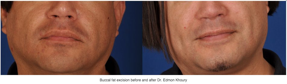 Buccal Fat Removal