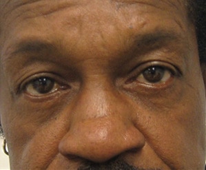 Case--8024 | After Blepharoplasty