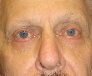 Case--5170 | After Blepharoplasty