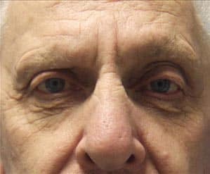 Case--5170 | Before Blepharoplasty