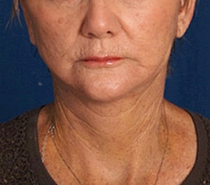 Case--8500 | After Facelift / Neck Lift
