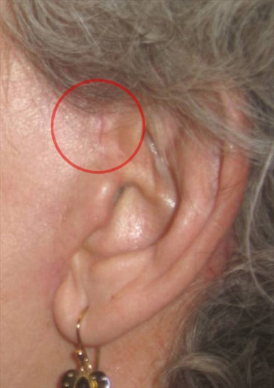 Case--5263 | After Incisions