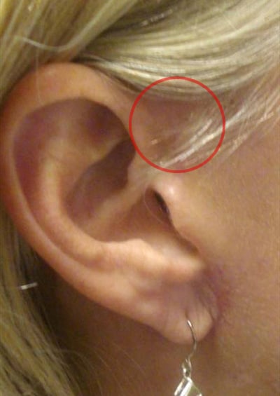 Case--4112 | After Incisions