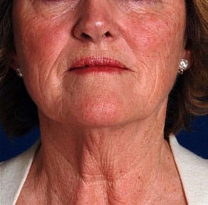 Case--8233 | Before Facelift / Neck Lift