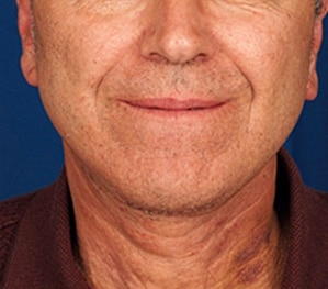 Case--8807 | After 1 Week Post-Op