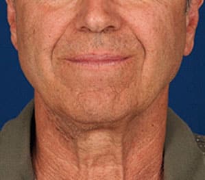 Case--8807 | Before 1 Week Post-Op