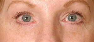 Case--3826 | After Blepharoplasty
