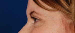 Case--8064 | After Blepharoplasty