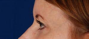 Case--8064 | Before Blepharoplasty