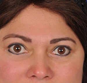 Case--3457 | After Blepharoplasty