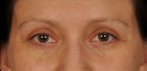 Case--9246 | After Blepharoplasty