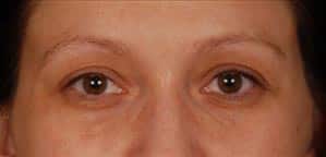 Case--9246 | Before Blepharoplasty