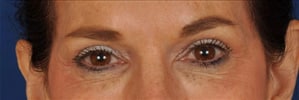 Case--5596 | After Blepharoplasty