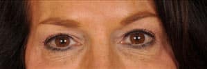 Case--5596 | Before Blepharoplasty