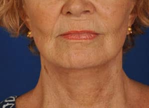 Case--4235 | After Facelift / Neck Lift