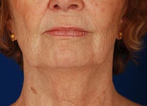 Case--4235 | Before Facelift / Neck Lift