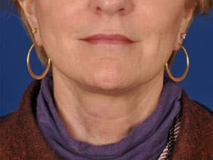 Case--3575 | After Facelift / Neck Lift