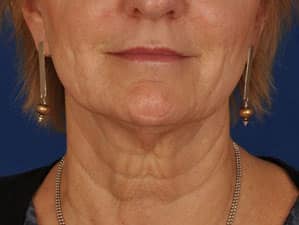 Case--3575 | Before Facelift / Neck Lift