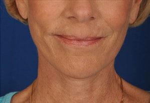 Case--1939 | After Facelift / Neck Lift