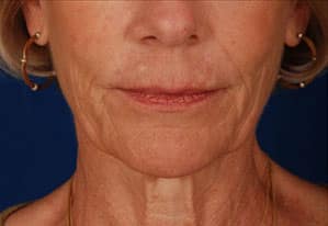 Case--1939 | Before Facelift / Neck Lift