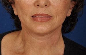 Case--1144 | After Facelift / Neck Lift