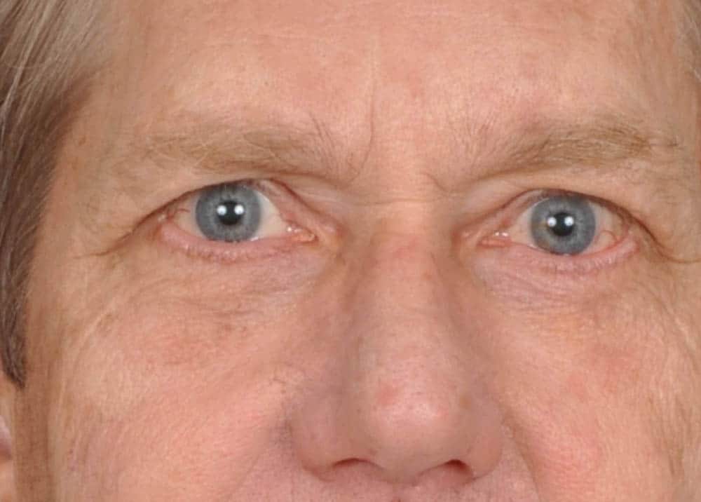 Blepharoplasty Photo Gallery Page 2 of 3 Denver Cosmetic Surgery