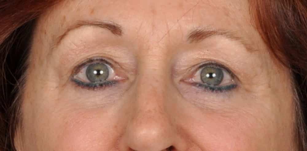 Case--1399 | After Blepharoplasty