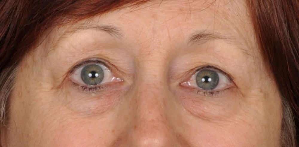 Case--1399 | Before Blepharoplasty