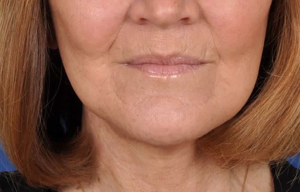 Case--2198 | After Facelift / Neck Lift