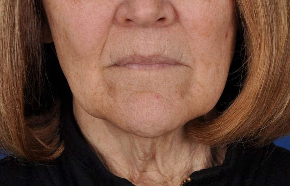 Case--2198 | Before Facelift / Neck Lift