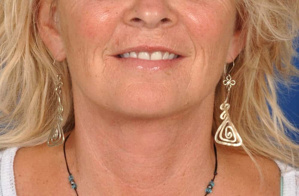 Case--4165 | After Facelift / Neck Lift