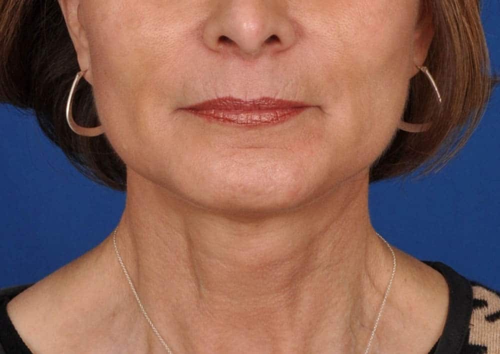 Case 1303 Denver Cosmetic Surgery Board Certified Plastic Surgeon