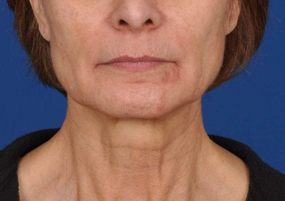 Case--1303 | Before Facelift / Neck Lift