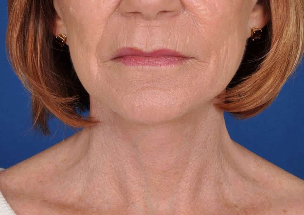 Case--7412 | After Facelift / Neck Lift