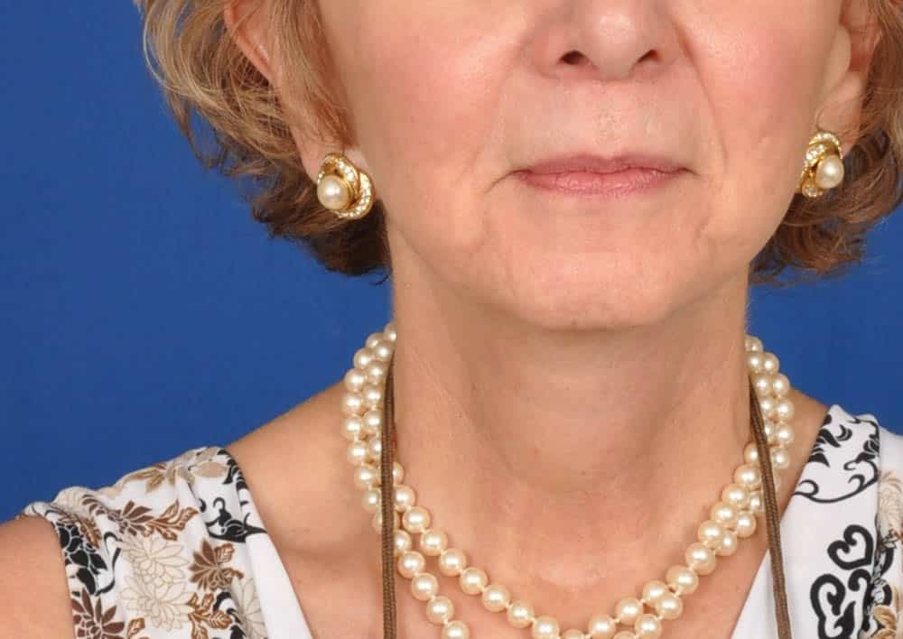 Case--6215 | After Facelift / Neck Lift